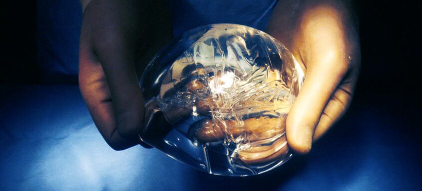 Silikona endoprotēze